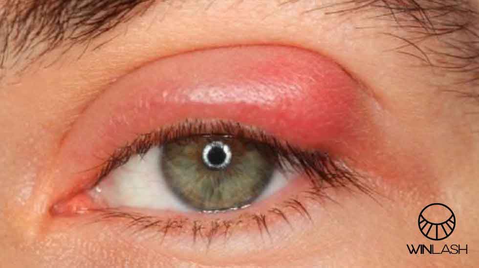 بلفاریت(Blepharitis )چشم چیست؟