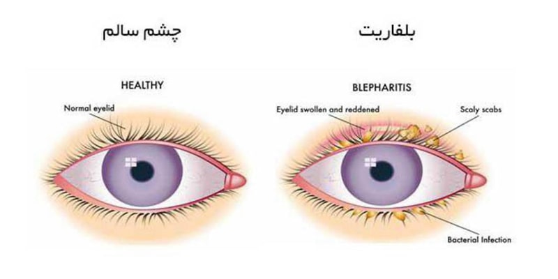 وینلش-علائم و نشانه های بلفاریت چشم