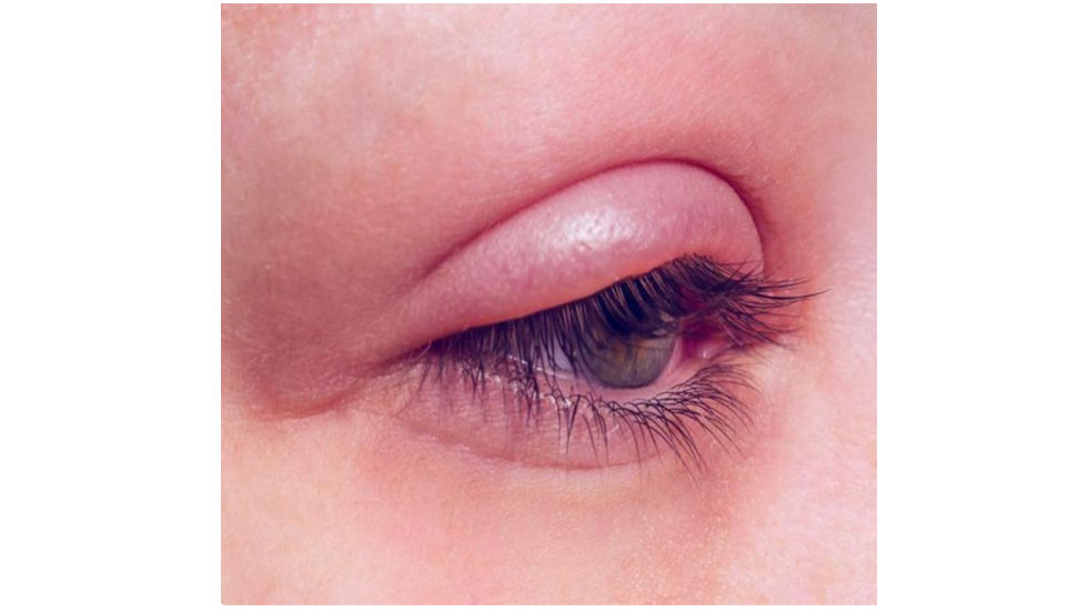 وینلش-درمان بلفاریت چشم