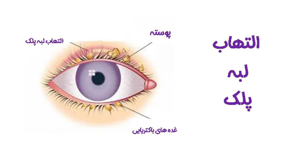 وینلش-بلفاریت(Blepharitis )چشم چیست؟