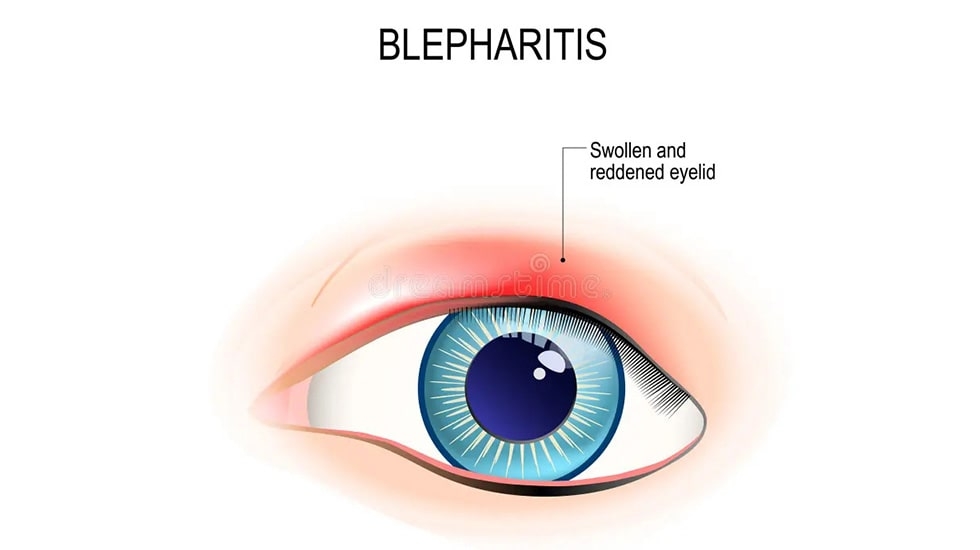 What is Blepharitis (Eyelid Inflammation)? | Winlash